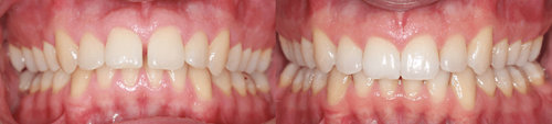 Clear Smiles Invisalign Before & After
