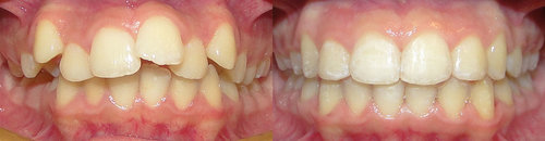 Invisalign Results Before and After in Dallas Texas - Case 1