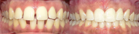 Invisalign Results Before and After in Dallas Texas - Case 1